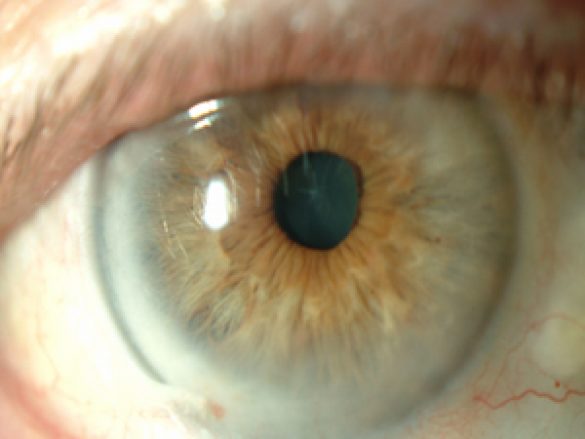 Queratitis neurotrófica ¿Qué es?