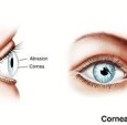 abrasion corneal
