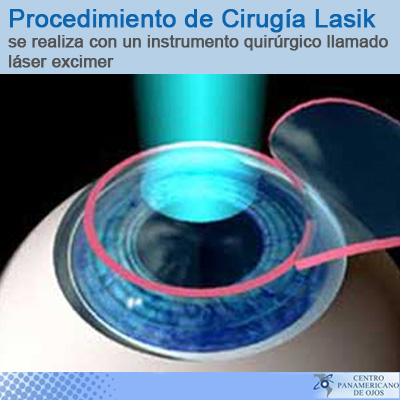 procedimiento con cirugia lasik