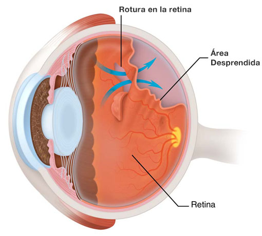 despendimiento-retina