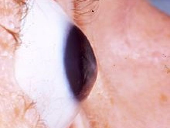 ¿Qué es queratocono?