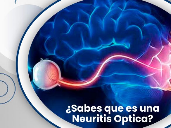 ¿Sabes qué es una Neuritis óptica?