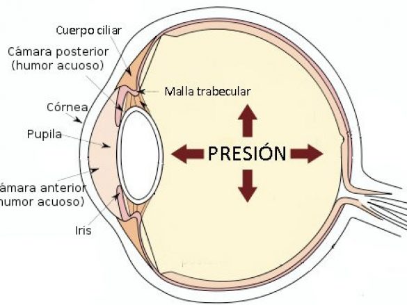 ¿Puedo desarrollar glaucoma si tengo la presión ocular elevada?