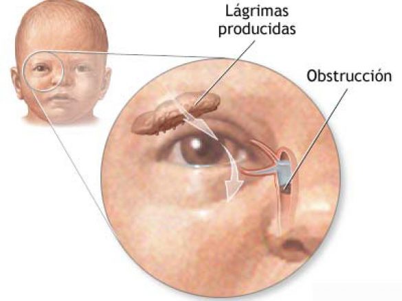 ¿Qué Es la Obstrucción del Conducto Lagrimal?
