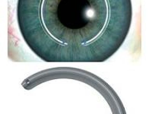 Anillos Intracorneales