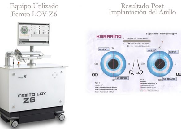Caso Clínico, Oftalmología- Uso del Femtosegundo