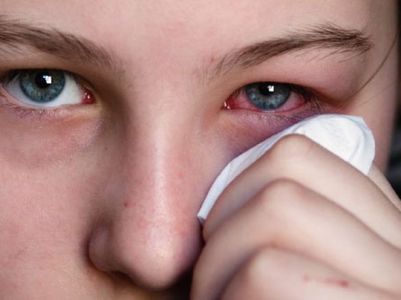Diferentes tipos de conjuntivitis