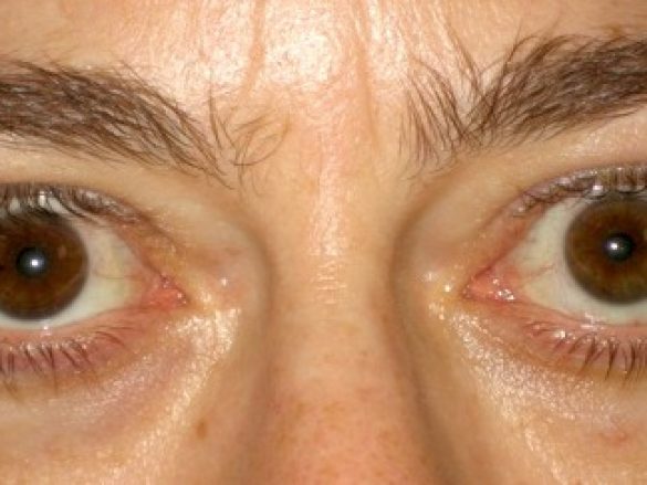 Tiroides y Ojos