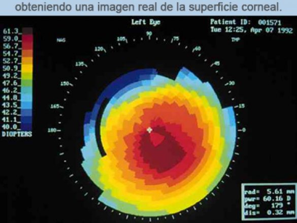 ¿Qué es la topografía corneal?