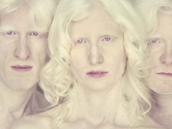 Albinismo ocular