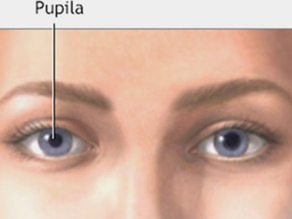 ¿Qué es la anisocoria