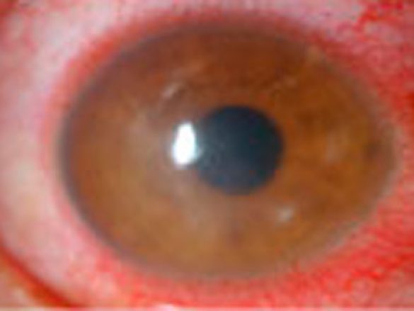 Inflamación de la córnea