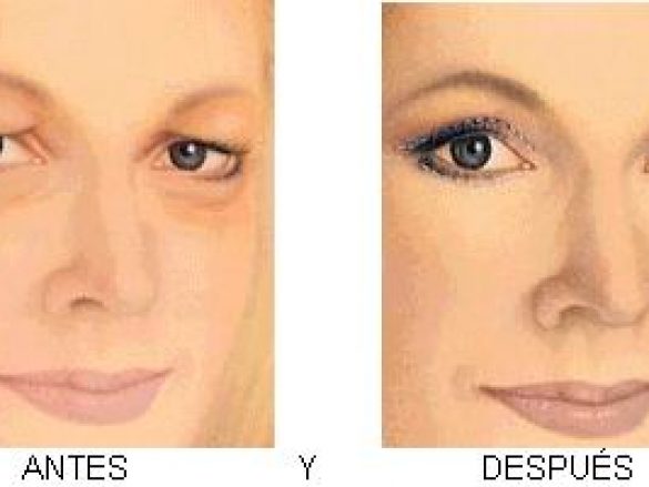 La Blefaropastía