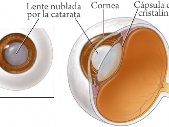 ¿Quién tiene riesgo de desarrollar cataratas?