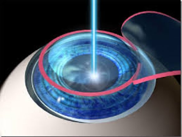 La cirugía refractiva