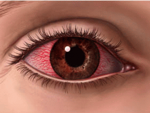 ¿Qué es la conjuntivitis?