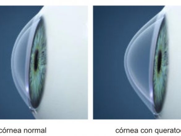 ¿Qué es el queratocono?