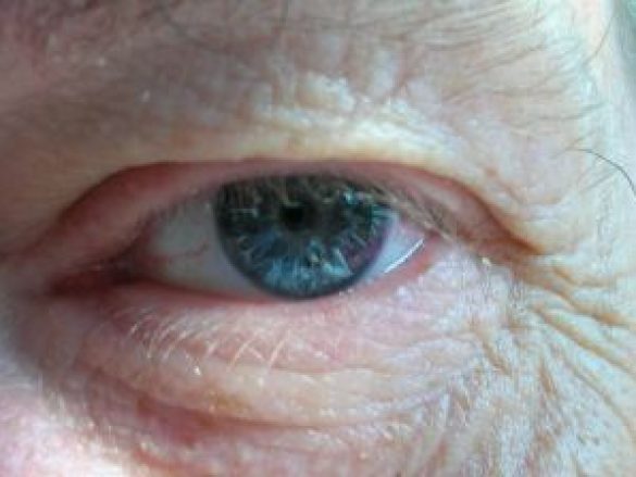 ¿Cuáles son los tipos de degeneración macular?