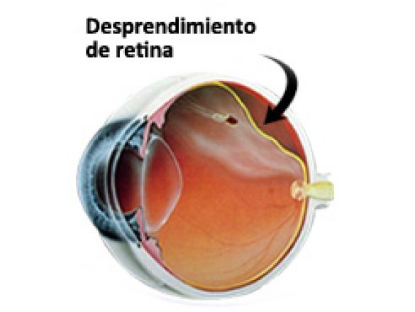 Desprendimiento de retina