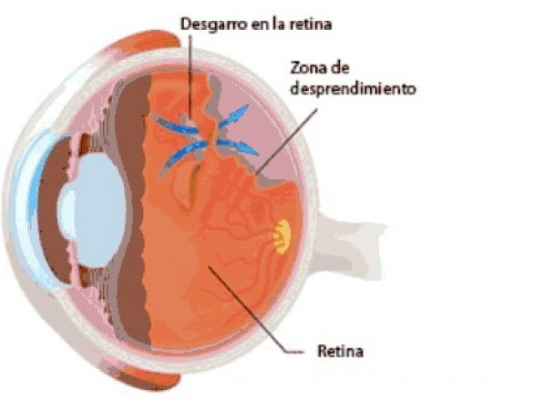 ¿Qué es el desgarro retinario?