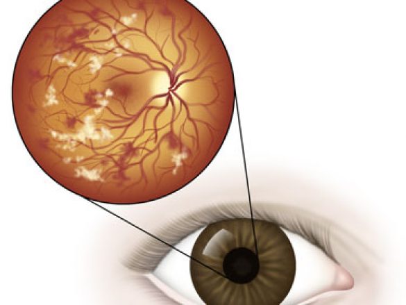 Como afecta la diabetes a los ojos
