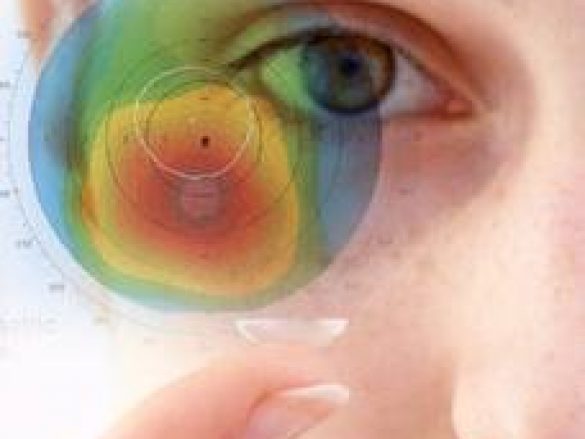 ¿Cómo se diagnostica el queratocono?