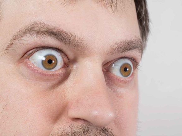 Enfermedad Ocular Tiroidea: Más allá de los ojos saltones