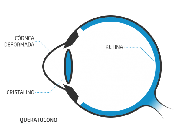 ¿Qué es Queratocono?