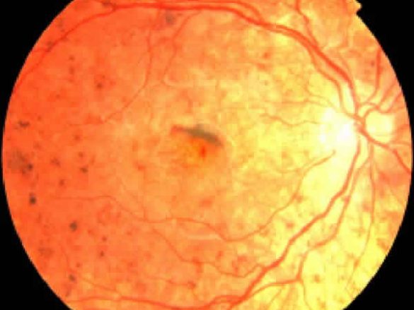 ¿Qué es la Retinosis Pigmentaria?