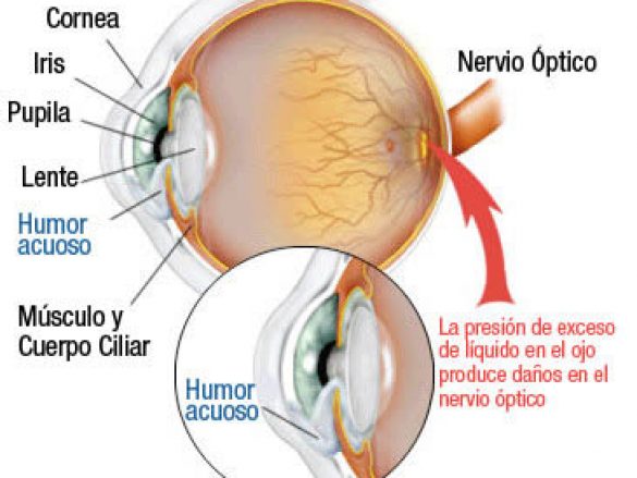 Tipos de glaucoma