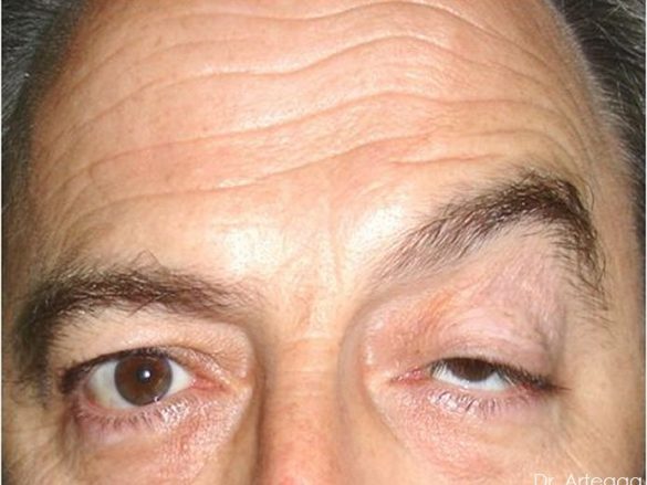 ¿Qué es Ptosis?