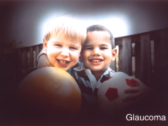 Lo que debes de conocer sobre el glaucoma