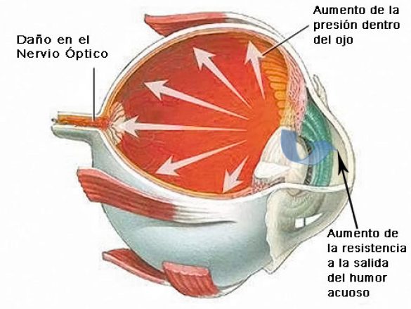 Tipos de Glaucoma