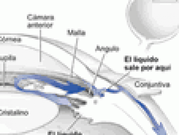 ¿Qué es el glaucoma?