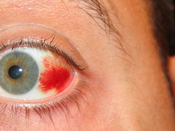 ¿Qué Es una Hemorragia Subconjuntival?