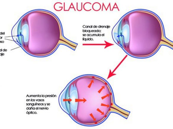 La importancia del diagnóstico y tratamiento temprano del Glaucoma