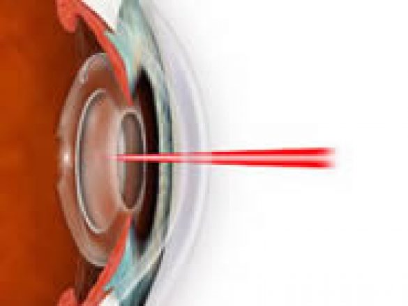 ¿Qué enfermedades pueden tratarse con cirugía laser?