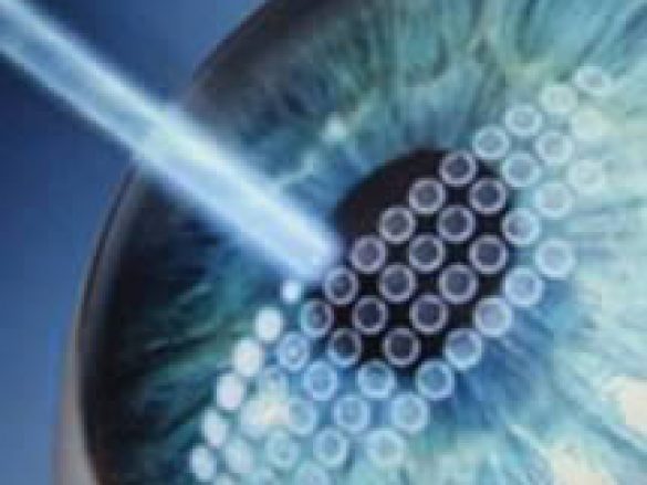 Los beneficios de la Cirugia Lasik