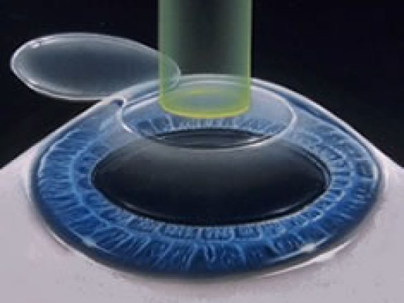 Cirugía Lasik