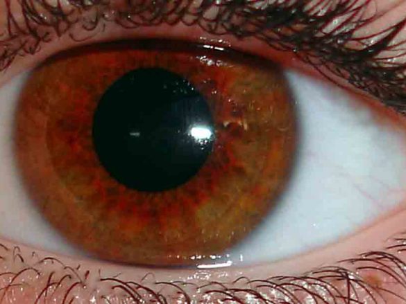 Lesiones oculares