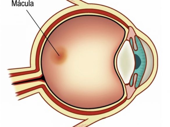 ¿Agujero Macular?