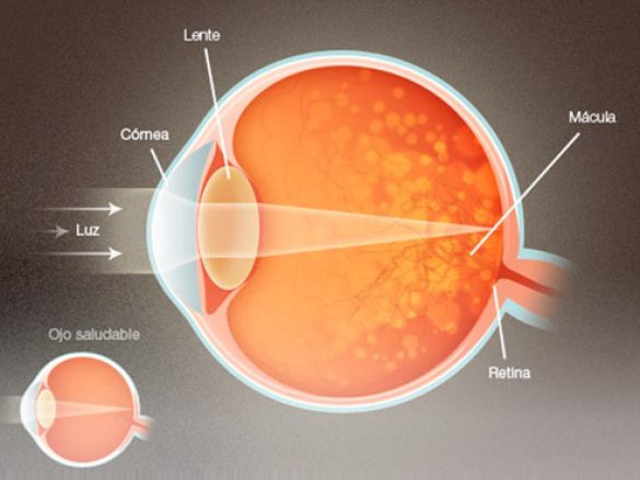 La degeneración macular seca