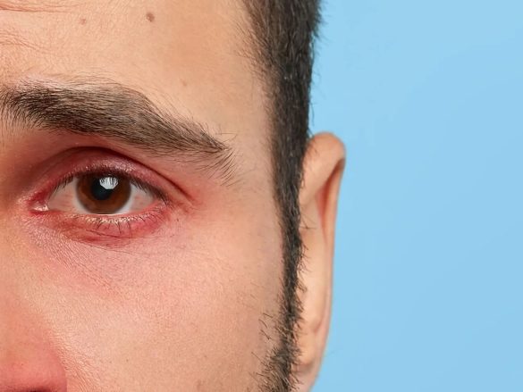 Señales de Alerta del Síndrome del Ojo Seco ¿Cuándo debes preocuparte?