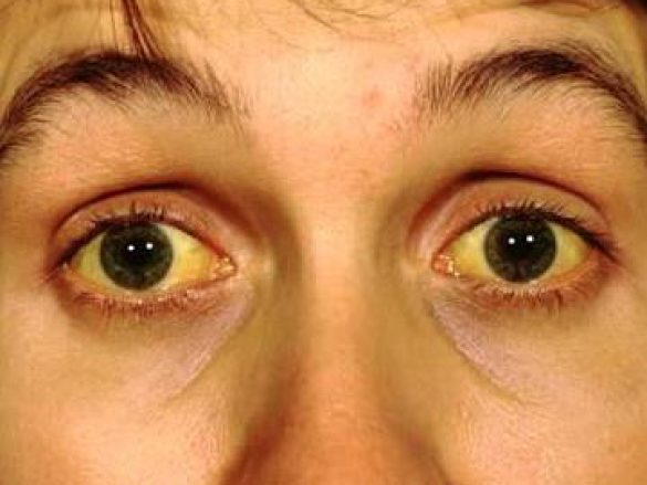 Ictericia u Ojos amarillos