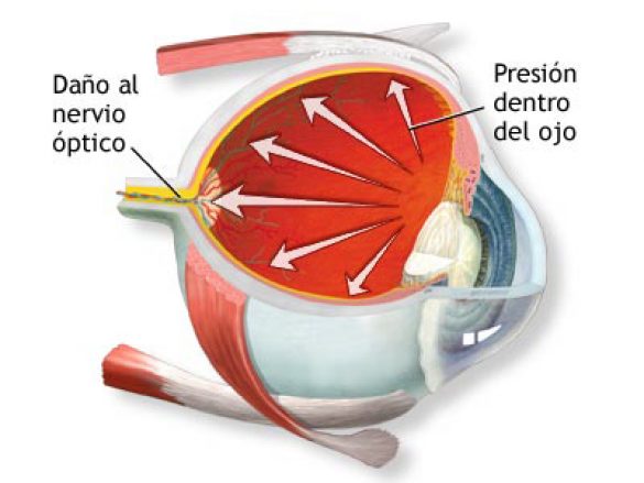 Día Mundial del Glaucoma- 12 de Marzo