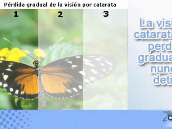 Cirugía de Cataratas