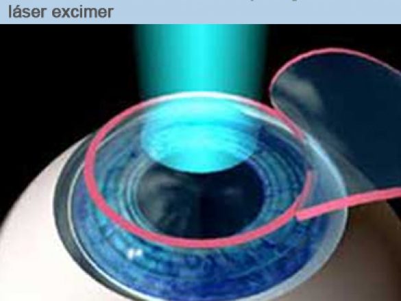 Cirugía Lasik