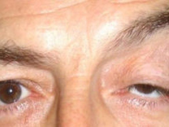 Causas de la Ptosis