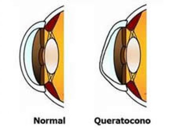 ¿Qué es  Queratocono?