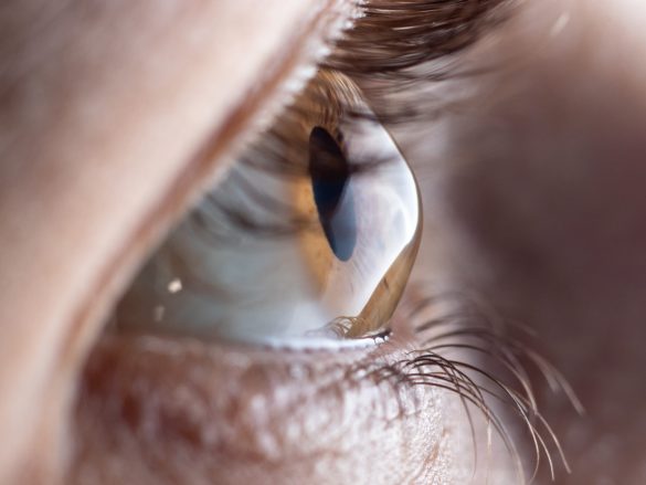 Queratocono: Todo lo que Necesitas Saber sobre esta Enfermedad Ocular